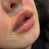 جشنواره آفر ویژه بوتاکس و فیلر