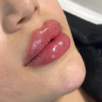 تزریق ژل و بوتاکس|خدمات آرایشگری و زیبایی|رشت, بوسار|دیوار