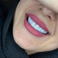 دندانپزشکی کامپوزیت لمینت|خدمات آرایشگری و زیبایی|قم, پردیسان|دیوار