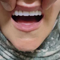 زیبایی کامپوزیت