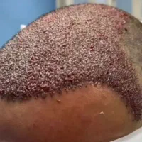 کاشت طبیعی مو ،ابرو،ریش،سیبیل|خدمات زیبایی و سلامت|شیراز, زرگری|دیوار