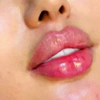 تزریق ژل لب فیلر زاویه سازی صورت فک گونه بوتاکس|خدمات آرایشگری و زیبایی|فردیس, خیام شرقی|دیوار
