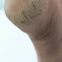 دوست داری ترک پاهات درمان بشه با یه قیمت منصفانه|خدمات آرایشگری و زیبایی|بندر انزلی, نوروزی|دیوار