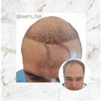 کاشت مو به صورت نقد واقساط وبا پرداخت آسان