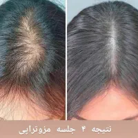 مزوتراپی مو ، ۳۰ درصد تخفیف برای جلسه اول|خدمات آرایشگری و زیبایی|نیشابور, ۲۲ بهمن|دیوار