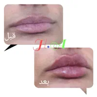 ژل وبوتاکس درمطب باقیمت استثنایی