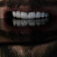 عصب کشی کانالی ۲/۵۰۰ روکش دندان در شرق تهران|خدمات زیبایی و سلامت|تهران, چهارصد دستگاه|دیوار