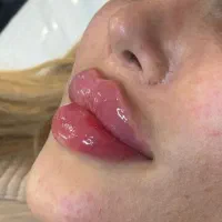خدمات ژل و بوتاکس ،خالبرداری ،مزوتراپی و