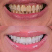 دندان سالم را با ماتجربه کنید اقساطی(دم قسط)|خدمات آرایشگری و زیبایی|راور, |دیوار