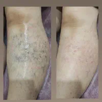 درمان تخصصی واریس