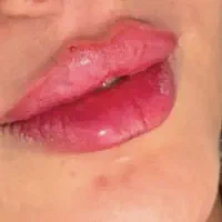 تخفیف ویژه ی فیلر (ژل)