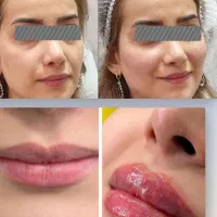 جشنواره تخفیف ژل بوتاکس مزو به مدت کوتاه درکلینیک|خدمات زیبایی و سلامت|اصفهان, ملک‌شهر|دیوار