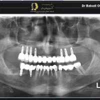 مرکز تخصصی ایمپلنت دیجیتال..|خدمات آرایشگری و زیبایی|تهران, زعفرانیه|دیوار