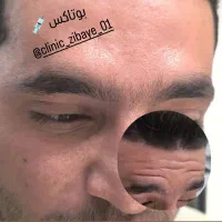 ژل وبوتاکس|خدمات آرایشگری و زیبایی|ایذه, |دیوار