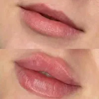 ژل،بوتاکس،تزریق چربی،بلفاروپلاستی،فیشیال