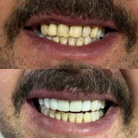 جشنواره دندانپزشکی (تمامی خدمات)|خدمات آرایشگری و زیبایی|اصفهان, لنبان|دیوار