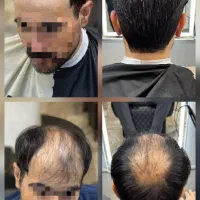 پروتز موی طبیعی و حرفه ای ویژه آقایان و بانوان|خدمات آرایشگری و زیبایی|کرمانشاه, |دیوار