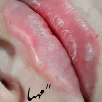 فیلر و بوتاکس وانزیم فیلر|خدمات آرایشگری و زیبایی|قم, دروازه چوبی|دیوار