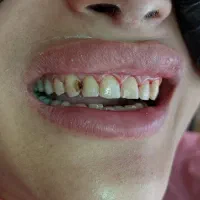 کامپوزیت 20تومن