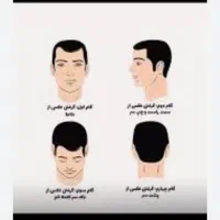 جشنواره کاشت مو