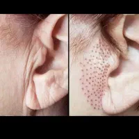 از بین بردن خال لک و کوچک کردن بینی و جای بخیه