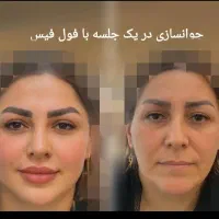 تزریق ژل و بوتاکس چربی فیلر