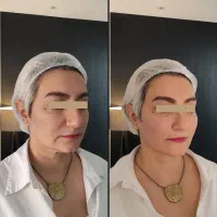 اجاره دستگاه اندولیفت (اندولیزر دو طول موج)