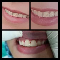 دندانپزشکی،ایمپلنت،ارتودنسی لمینت وکامپوزیت اقساطی|خدمات آرایشگری و زیبایی|نجف‌آباد, شریعتی غربی|دیوار