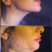 ساکشن غبغب همراه با زاویه‌سازی