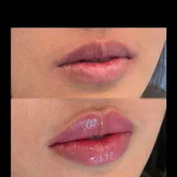فیلر وژل وبوتاکس|خدمات آرایشگری و زیبایی|تهران, کیانشهر|دیوار