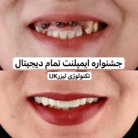 هر4واحد ایمپلنت دیجیتال+1ایمپلنت رایگان/کاشت دندان|خدمات آرایشگری و زیبایی|تهران, پاسداران|دیوار