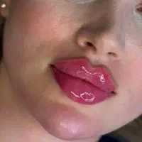 ژل بوتاکس آنزیم مزو چال لپ آموزش پرسینگ گوش