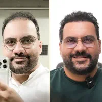 کاشت مو با ۱۳ میلیون تخفیف