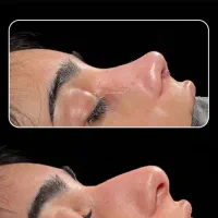 تخفیف ویژه جراحی و عمل بینی/پلک