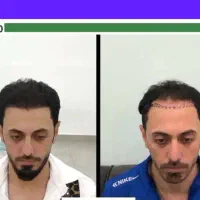 کاشت موکاشت ابرو+ اموزش کاشت مو نقد، اقساط تضمینی|خدمات آرایشگری و زیبایی|شیراز, عفیف‌آباد|دیوار