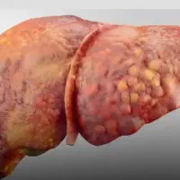 پا‌کسانی کبد چرب