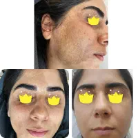 رفع کک مک پلک مزونیدلینگ تخفیف ویژه