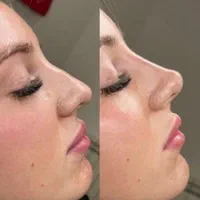 فیلر بینی  برطرف کردن قوز بینی  بینی شکسته و کج|خدمات آرایشگری و زیبایی|خرم‌آباد, |دیوار