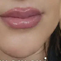 تخفیف ویژه بوتاکس و فیلر