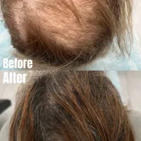 مزو تراپی پی ار پی بوتاکس