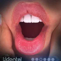 کامپوزیت لمینت ایمپلنت اقساط ویژه