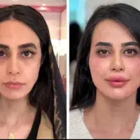 ب تعدای مدل برای فیلرلب بوتاکس