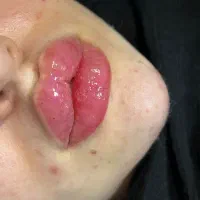 ژل،بوتاکس،مزو،چال لپ،فیلر|خدمات آرایشگری و زیبایی|قم, عمار یاسر|دیوار
