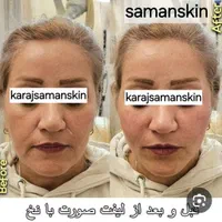 جشنواره مرکز تزریق چربی صورت ،ژل ،بوتاکس.prp