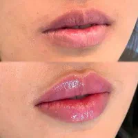 جشنواره  یلدایی تزریق ژل فقط و فقط هر سیسی ۱ ملیون|خدمات آرایشگری و زیبایی|همدان, |دیوار