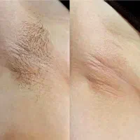 پک موبر دائمی آکنرا|آرایشی، بهداشتی، درمانی|تهران, چیتگر جنوبی|دیوار