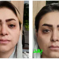 تنهامرکزلیفت صورت،بابیشترین تعدادنخاردارونخبدونخار|خدمات آرایشگری و زیبایی|مشهد, نیروی هوایی|دیوار