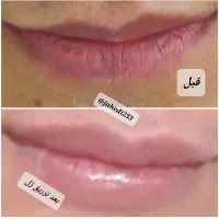 خدمات زیبایی مزووایت نیدلینگ پلکسر ژل بوتاکس