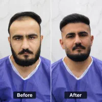 کاشت مو توسط تکنسین های شیراز با تخفیف ویژه|خدمات زیبایی و سلامت|کرمانشاه, |دیوار