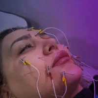 جوانسازی بادستگاه آکولیفت۴۹۰ جایگزین بوتاکس وهایفو